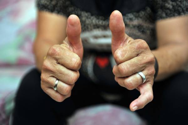 樺姐跟隨其師父學習推拿至今已有30多年的時間，拇指經已變形，是她那推拿功力的經驗見證。
