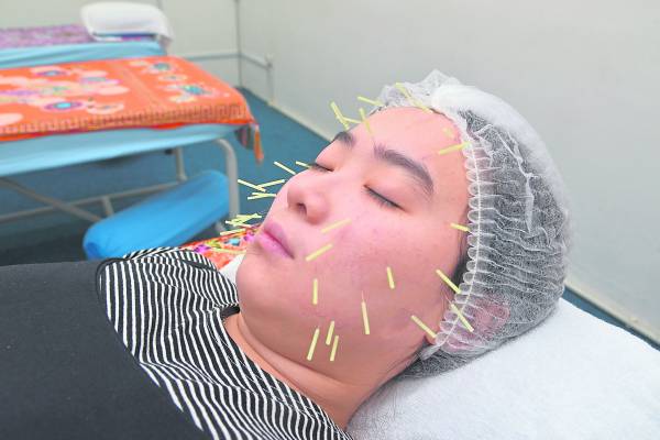 传统针灸美容使用极细的细针在脸部针灸,可以促进胶原蛋白再生、延缓肌肤衰老。