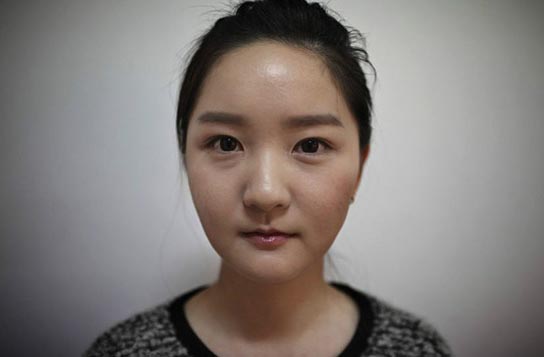 消肿后,整容的效果还是挺明显的。相较于之前整个人都明朗很多,脸小了,气质也好了。