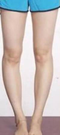 O型腿