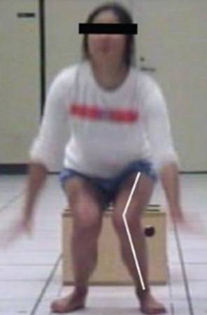 膝外翻