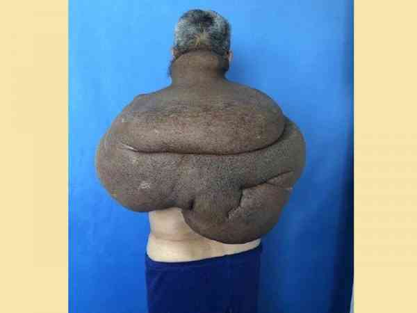 唐男肿瘤几乎覆盖上半身。