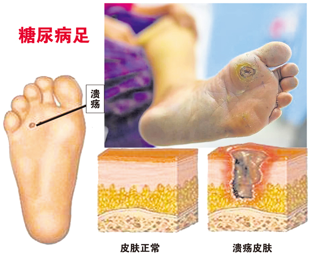 【保健"脚冰凉"糖尿病足悄悄来 新生活报 ilifepost爱生活