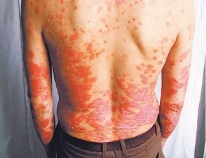 牛皮癣是一种常见慢性炎症性皮肤病,其特征是红丘疹或斑块上覆有多层银白鳞屑。