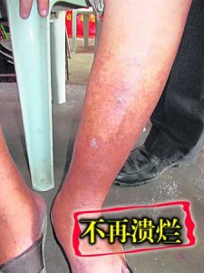 曾经饱受皮肤溃烂折磨的蓝佩英,经过颜医师圣手治疗后,皮肤不再血脓烂湿。