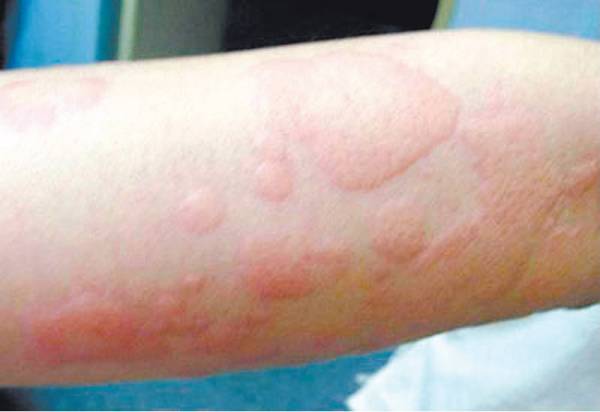 孕妇长荨麻疹 喝草药排热毒安胎