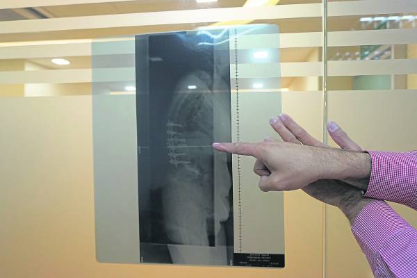 Andy妈妈的X光片显示，脊椎骨曾经上螺丝巩固。 