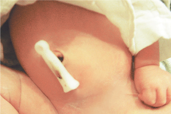 宝宝脱落的脐带，可在宝宝受惊吓时，有着压惊作用。