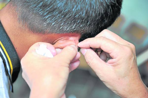 红线缝衣针对准耳朵的穴道施针再穿出，以刺激穴位改善视力，一次疗程不到一分钟，十分快速见效。