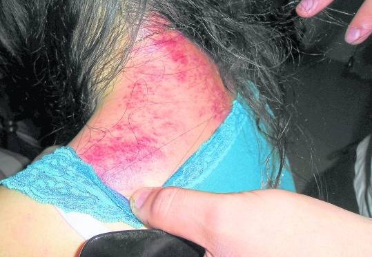 患有失眠、落枕、颈椎等疾病者,刮拭颈部有助治疗及解决这些问题。