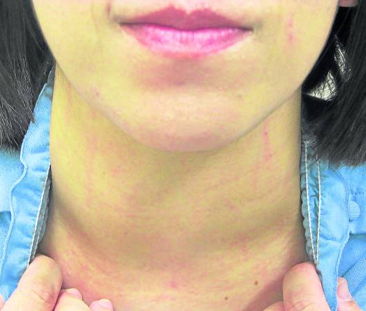 甲状腺肿大(俗称:大颈包),会导致病患手震、疲劳、体重减轻,严重的则会心脏跳动紊乱及因心理衰竭而导致脚肿、气促,甚至还会威胁生命。