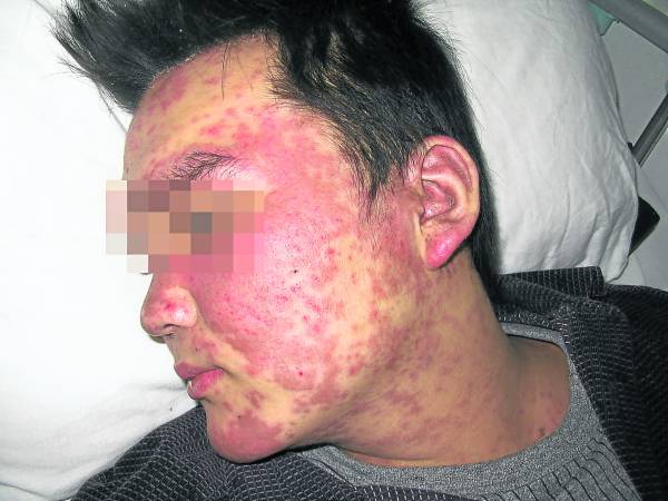 红斑狼疮症被很多人误以为是皮肤病,但其实,它是因人体免疫系统遭到破坏而影响到皮肤。而且,此病不管是中西医都没有一个很好的治疗方案,但网络就流传,把一些中药混合在一起, 就能治疗这难缠的红斑狼疮。