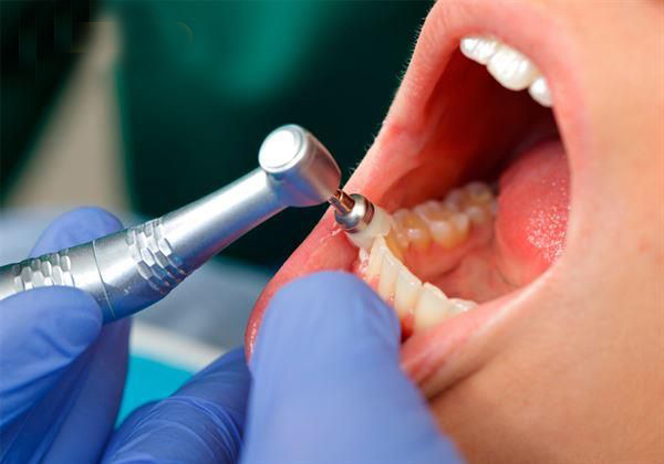 每3个月到半年进行1次洗牙治疗，帮助清除堆积于牙根表面的牙结石、降低牙菌斑的堆积。