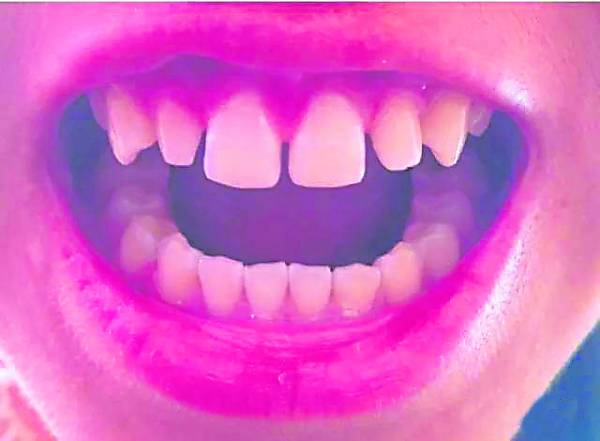 洗牙并不会造成牙缝变大的问题，乃清除了牙结石，舌头直接接触到牙缝而已。
