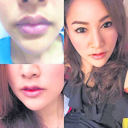 “krachap唇”泰国女性掀起奇葩整容潮，医生们都无可奈何地拒绝了！