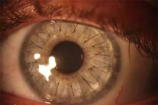 眼球在角膜移植后的样子。