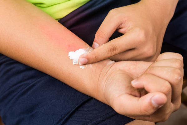 Baking soda being used to relieve itching from rashes.