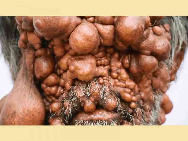 全身长满肿瘤是啥样?