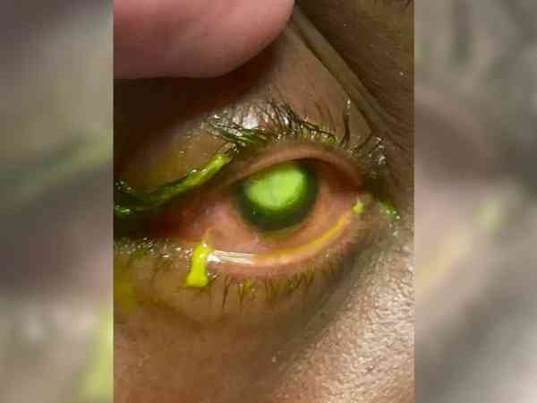 当病人眼晴受感染时，医生会在眼球注入萤光显影剂。图／翻摄自Vita Eye Clinic面书 