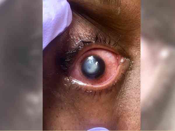有患者戴隐眼睡觉，导致眼球发白。图／翻摄自Vita Eye Clinic面书
