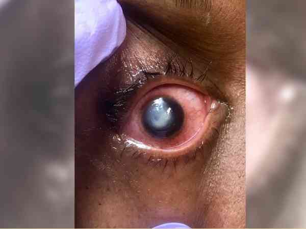 有患者戴隐眼睡觉,导致眼球发白。图/翻摄自Vita Eye Clinic面书