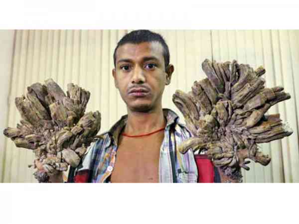 树人主动要求截肢