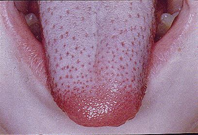 一名5岁小孩高烧3天,还出现舌头红肿发炎,味蕾颗颗分明的危险征兆