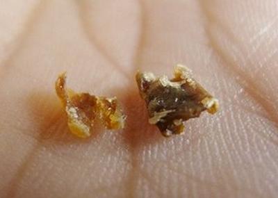 耳屎是这样的人要注意,可能是疾病征兆!