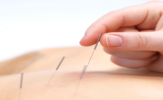 针灸疗法不止扎针而已