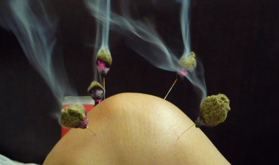 针灸治疗就是结合"针法"和"灸法",先在相关部位上扎针,然后在针柄上