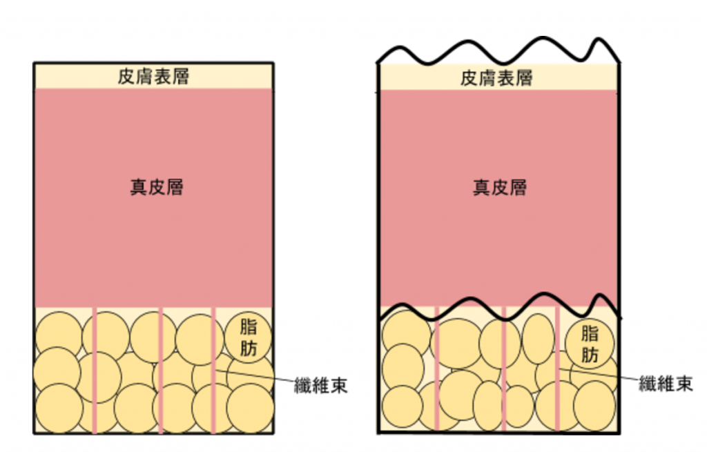左为正常肌肤,皮肤表层显得平滑;右为橘皮组织,可能因为肥胖、皮肤弹性不好、荷尔蒙失调等等原因造成,可以看见皮肤表层已经变得不平整。