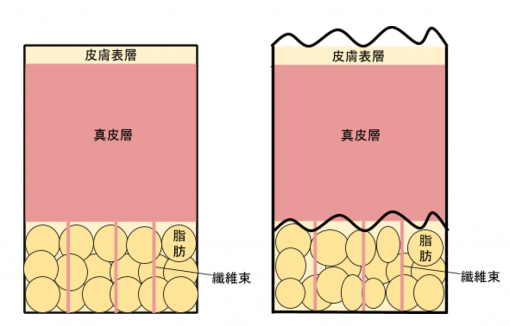 左为正常肌肤，皮肤表层显得平滑；右为橘皮组织，可能因为肥胖、皮肤弹性不好、荷尔蒙失调等等原因造成，可以看见皮肤表层已经变得不平整。