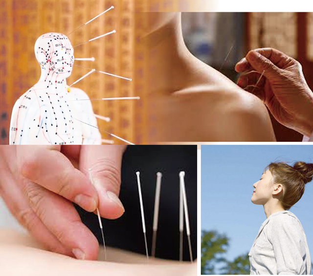 第一次做针灸难免会紧张,最重要心情保持放松.