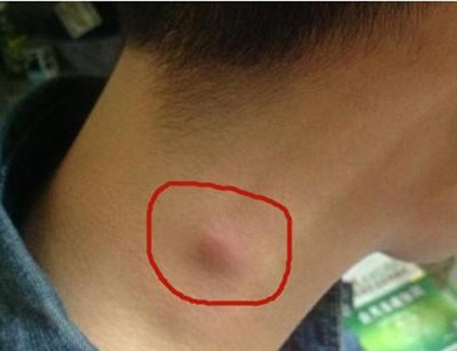 保健你身体表面有肿大的淋巴结吗