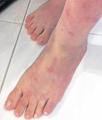 美美双脚无缘无故出现了许多斑点疹，最后竞含脓，屡医难愈。