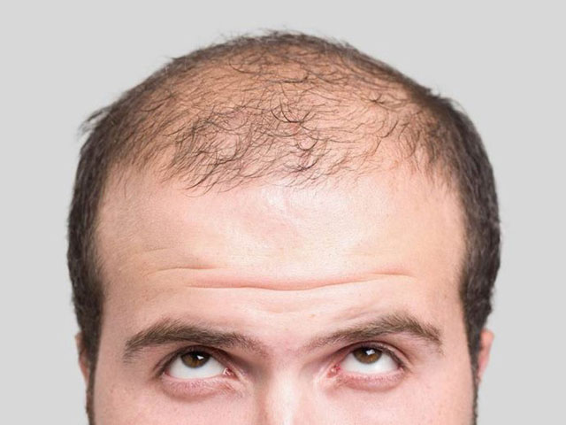 现代的年轻人，生活作息不规律，难免出现不健康的症状，尤其头上的头发也开始提早掉发。 