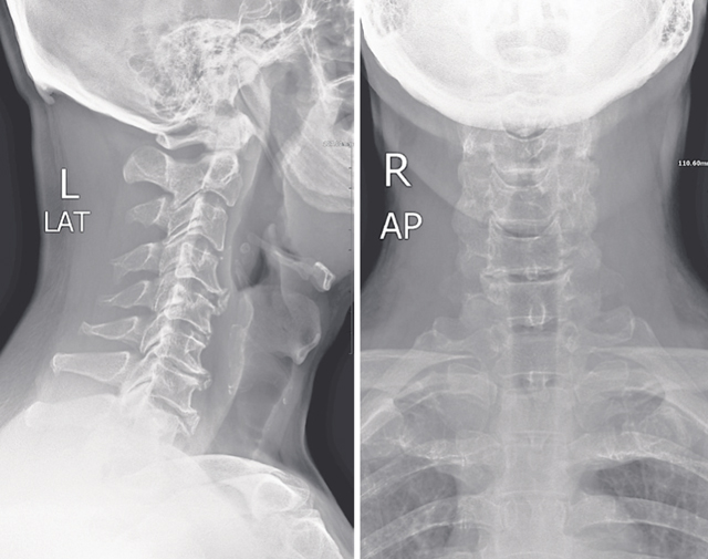颈关节错位引起的颈椎病还需要拍X光线配合诊断，才能精准的治疗错位部分。