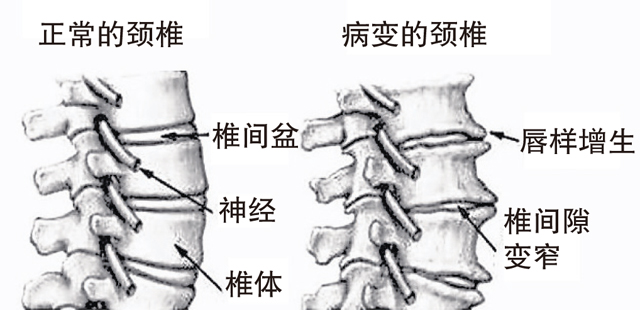 正常的颈椎与病变的颈椎对比。