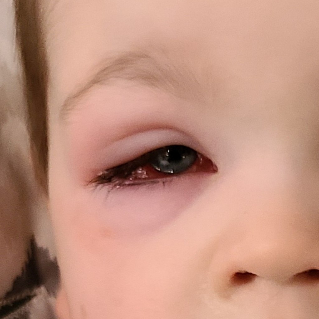 男童双眼红肿发烧 细菌入眼险失明