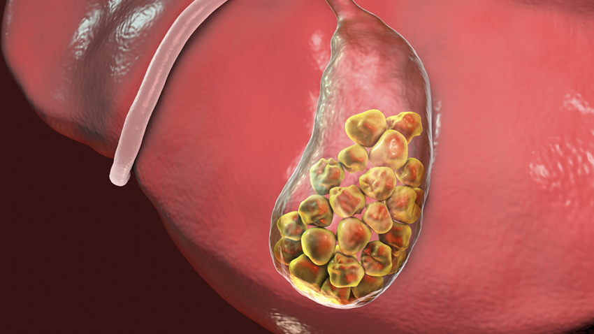 Gallstones, 3D illustration showing bottom view of liver and gallbladder with stones