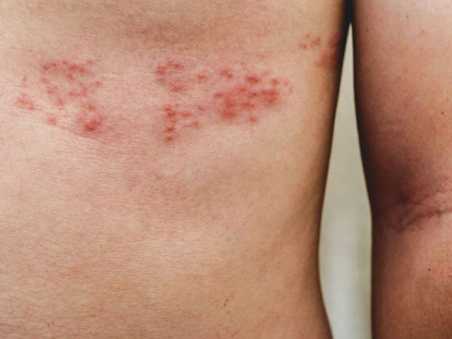 感染带状疱疹是转移性痛楚导致腰背痛的例子之一。