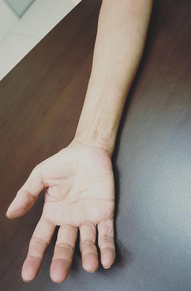 出现手麻痹症状