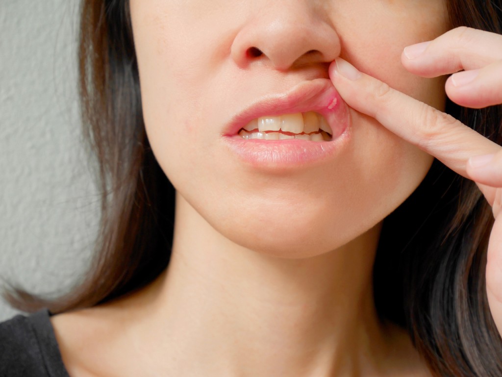 Canker sore on woman upper lip