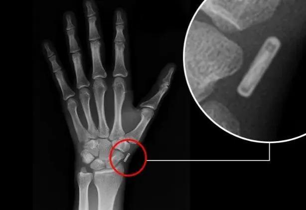 诺亚体内遭植入的不明物体X光片。