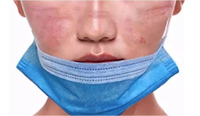 长期戴口罩,容易使局部肌肤出现红肿、磨破的现象,这些细小的伤口处也更容易感染发炎,最终形成“口罩脸”。