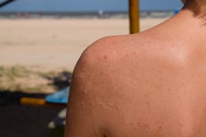 Sunburn on the skin of the back. Exfoliation, skin peels off. Dangerous sun tan.