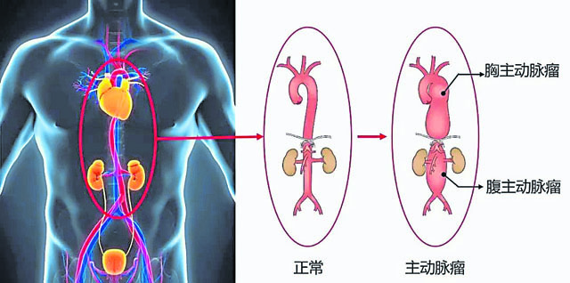 主动脉是人体最大的血管，当主动脉直径不正常膨胀时，便会产生所谓的主动脉瘤，最常见的则是脑部与腹部的主动脉。