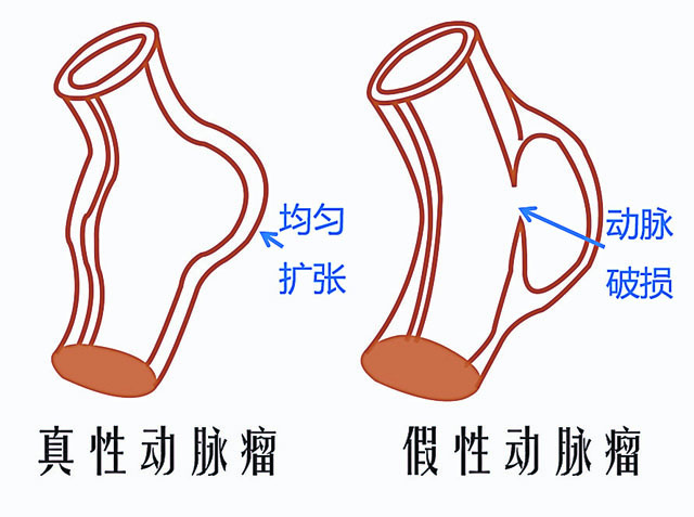 主动脉瘤可以分成真性与假性。