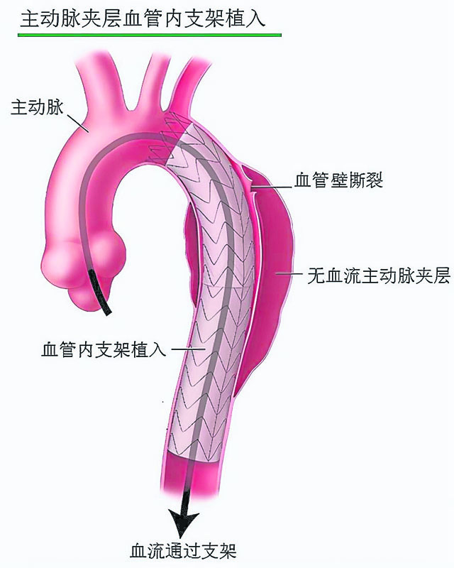主动脉瘤可以通过血管内支架置放术治疗。