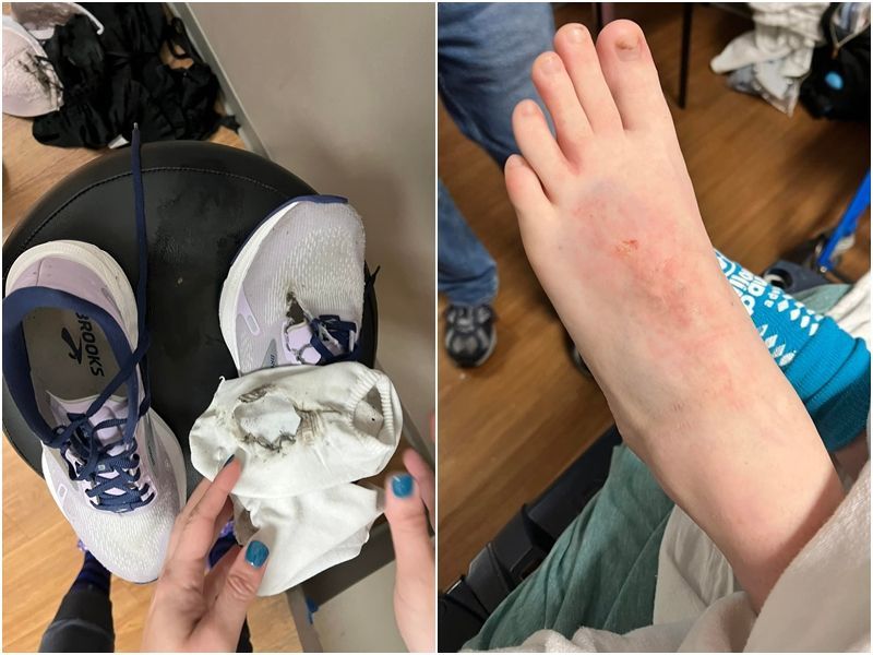 雷击甚至让她的鞋子、袜子被烧穿。